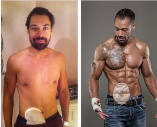 Illustration for article titled Male Bodybuilding Model Shows Off His Colostomy Bag